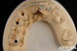 Experience Ultimate Esthetics With Aesthetically Pleasing Dental Implant Crown