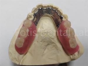 China OEM Flexible Removable Partial Denture  Easy To Clean / Maintain on sale