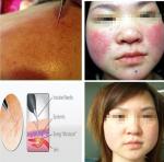 2015 Professional acne and vascular removal