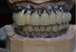 Corrosion Resistant Co Cr Implant Supported Metal Crown Biological Material