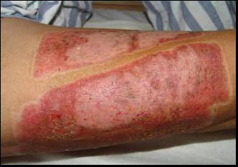 good quality diabetic ulcers red LED light therapy wound healing equipment