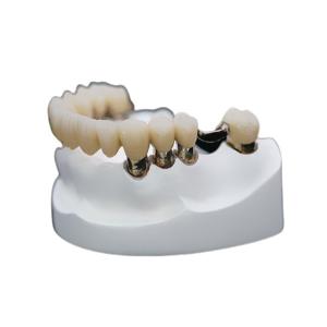 Quality Corrosion Resistance Dental Telescopic Crown Precision Attachment Denture Strong Stability wholesale