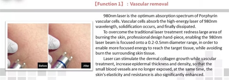 Portable Diode 980nm Laser Spider Vein Removal Machine / Vascular Laser Machine