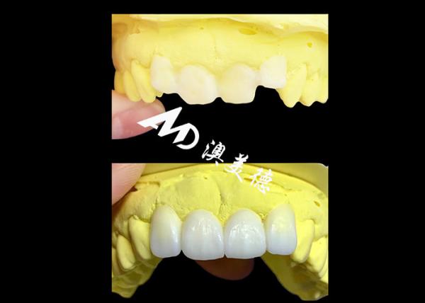 Cheap Custom Translucent Zirconia dental Crowns Crafted by AMD Dental Lab for sale