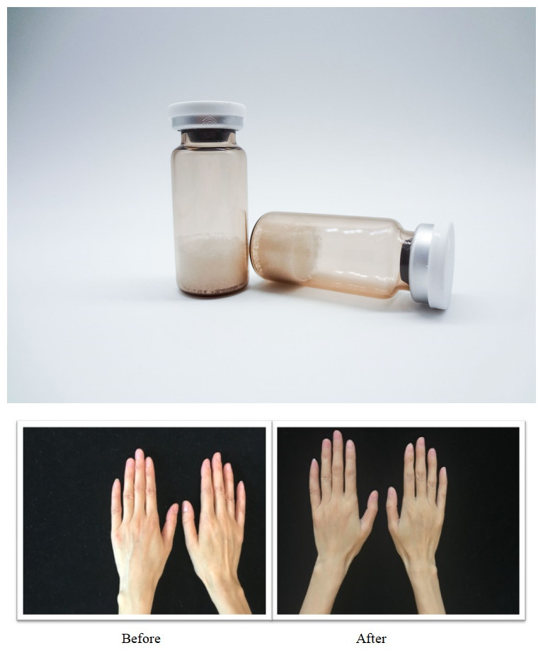 Injectable Poly L Lactic Acid Facial Filler Non-Surgical Treatment Remove Face Wrinkles Improve Skin Elasticity
