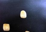 Strong Cosmetic PFM Porcelain Fused Metal Crown Colour Stability