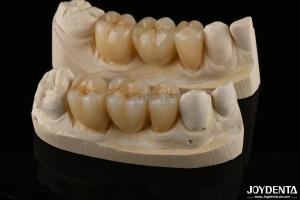 Quality Wear Resistant Zirconia Full Contour Dental Crown High Translucency wholesale