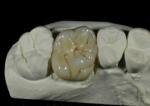 CE ISO Flexible Porcelain Dental Crown For Back Teeth Restoration