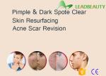 Co2 laser vaginal rejuvenation treatment/co2 Fractional Laser/skin resurfacing