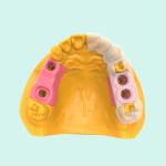 Customized Surgical Guides Flexible Planting Guide Resin