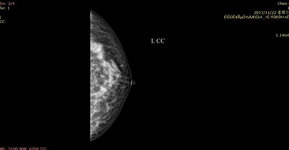 Full Digital Mammography System with Panel Detector for Sales