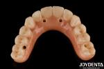 Dental Ti-Bar Hybrid Zirconia Bridge Excellent Strength Restores Chewing