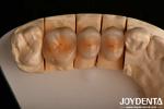 High Chipping Resistance And Natural-looking Esthetics With Multilayer Full