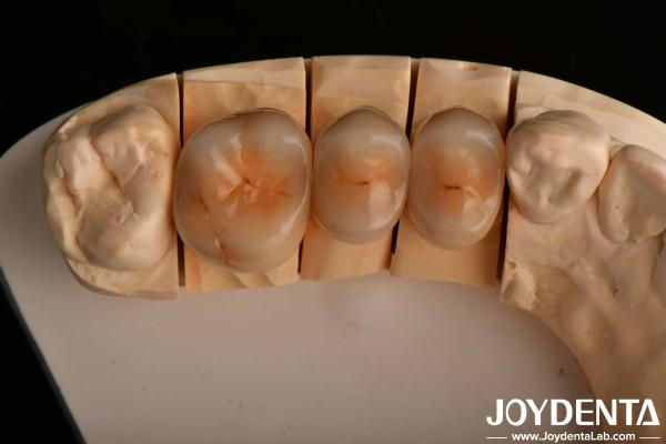 High Chipping Resistance And Natural-looking Esthetics With Multilayer Full