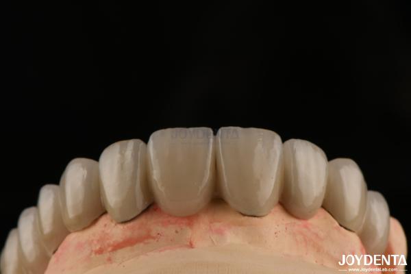 PFM Porcelain Fused to Metal Crowns and Bridges Seamless Bonding for Natural