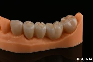 Quality Precision Dental Restorations Full Zirconia High Flexural Strength Natural Color wholesale