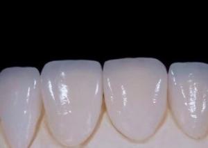 Quality EMAX Durablity CAD/CAM Dental Composite Veneers Highly Detailed Accurate wholesale