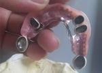 Flexible Durable Precision Attachment Denture Corrosion Resistant
