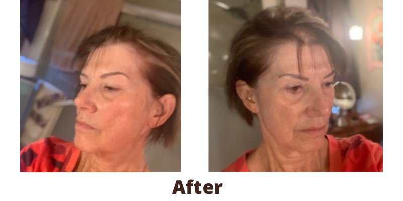 OEM ODM Alopecia Areata Laser Hair Growth Caps For Hair Rejuvenation