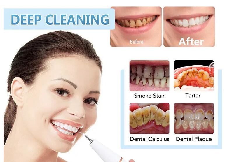 2.1W 1A Ultrasonic Tooth Cleaner Dental Calculus Remover OEM ODM