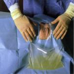 Surgical Fenestration Eye Sheet Drape With Integrated Fluid Collection Bag