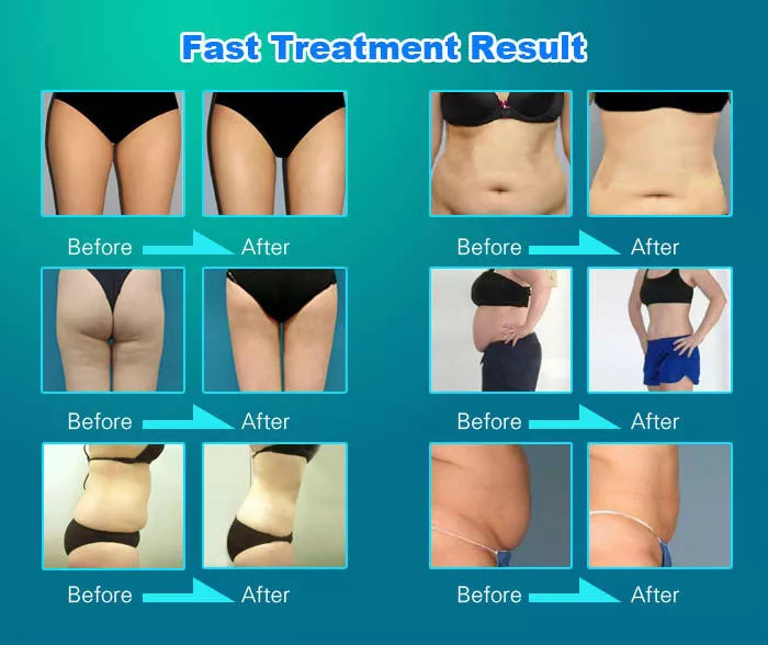 Radio Frequency Face Lifting Machine 28khz 33khz 40khz Cellulite Massager Body Sculpting Machine