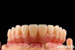Comfortable Wear Acrylic Denture Finished With Tooth Arrangement Technology