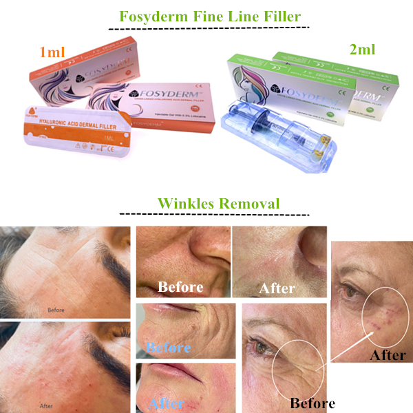 Anti Wrinkle Lips Face Oem Cross Linked Dermal Filler Injection