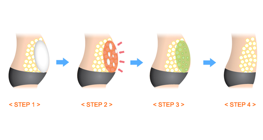 Removing Body Fat Injecting 10ml Hyamely Lipolytic Solution Thin