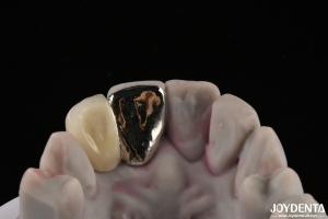 Quality Metallic Dental Maryland Bridge Good Chewing Function For Long Lasting Remediation wholesale