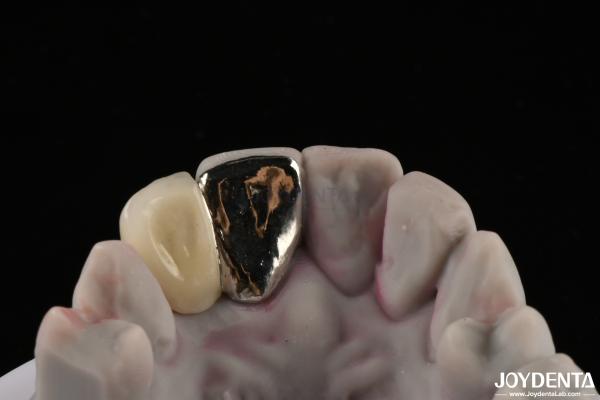 Metallic Dental Maryland Bridge Good Chewing Function For Long Lasting