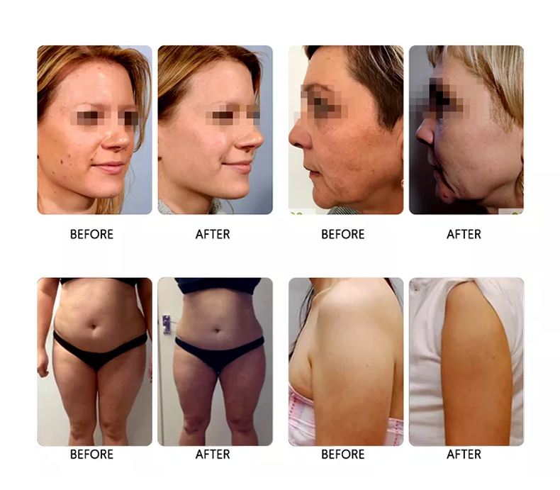 Fat Loss HIFU Slimming Machine Ultra 9D Face Lift Skin Tightening