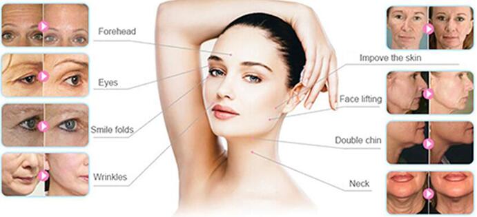 hifu machine / high intensity focused ultrasound hifu for wrinkle removal / hifu face lift