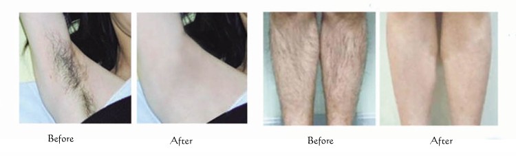 TUV Medical Full Body Laser Hair Removal Machine Sliding Therapy CE ISO13485