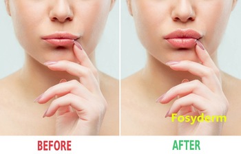 2ml High Quality Injectable Hyaluronic Acid Gel Dermal Lip Fillers