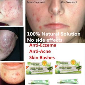 Quality natural anti-bacteria gel anti acne anti eczema herbal gel wholesale