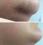 Triple wavelength diode laser machine for hair removal pemanently and painless