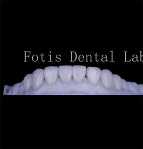 Quality Long Lasting Smooth Texture Teeth Cover Veneers Natural Dental Veneers wholesale
