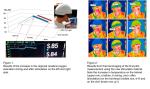Near Infrared Led Light Helmet Parkinson'S Stroke Dementia Nervous System