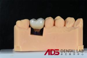 Quality Dental Missing Teeth Cement Retained Implant Crown Replacement Custom wholesale