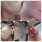 New product ideas 40W medical fractional CO2 laser for Acne removal and scar