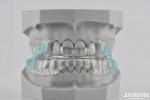 Custom Fitting Sleeping Aid Mouthpieces Dental Appliance To Stop Snoring