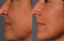 IPL Beauty Machine Pigment Removal Skin Rejuvenation Beauty Salon Upper Lip
