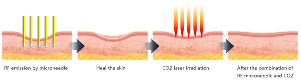 50W fractional rf microneedle machine for skin rejuvenation