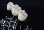 Metal Framework PFM Dental Crown