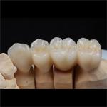Biocompatible Zirconia Ceramic Dental Crown Tooth Restorations Custom