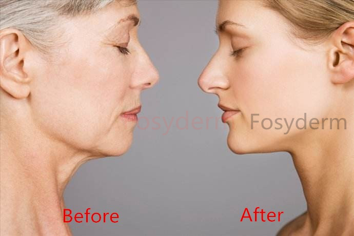 Skin Care HA Cross Linked Dermal Filler For Face Injectable Long Lasting