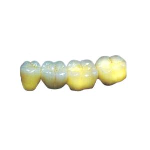 Quality Wear Resistant PFM Dental Crown High Strength Aesthetic Allergy Friendly wholesale