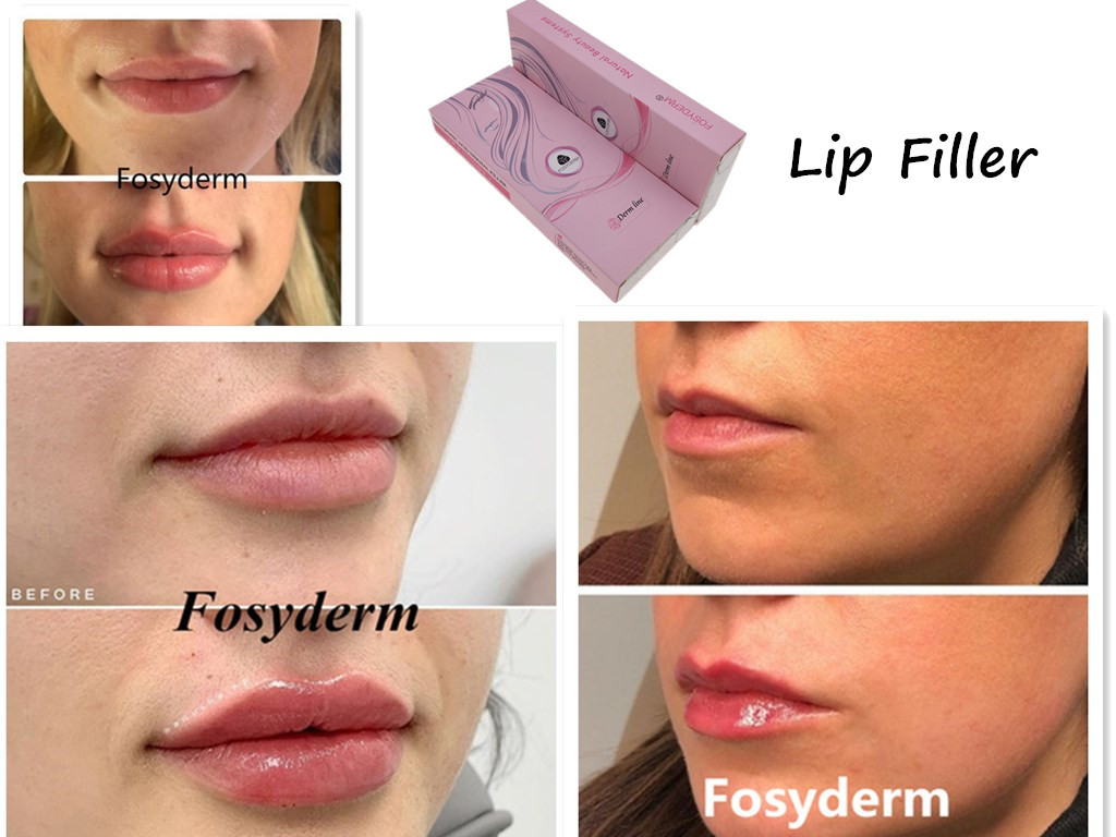 Clear Fosyderm Facial Chin Hyaluronic Acid Dermal Filler BD Syringe For Nose