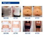 Fat Freeze Cavitation Cryolipolysis Slimming Machine Cellulite Reduce With 4